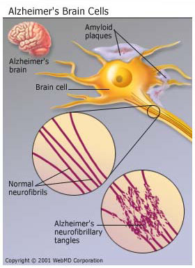 Click image for larger version

Name:	understanding_alzheimers_disease_basics_Alzheimers_Brain_Cells.jpg
Views:	1
Size:	37.0 KB
ID:	522